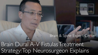 Trattamento della fistola arterovenosa durale cerebrale. Fistola arterovenosa durale cerebrale (FADC). 10