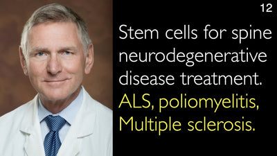 Cellule staminali per il trattamento delle malattie neurodegenerative della colonna vertebrale. Sclerosi laterale amiotrofica (SLA), poliomielite, sclerosi multipla. 12